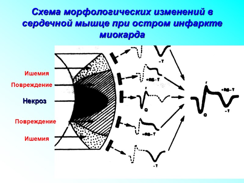 Схема морфологических изменений в сердечной мышце при остром инфаркте миокарда Ишемия Повреждение Некроз Повреждение